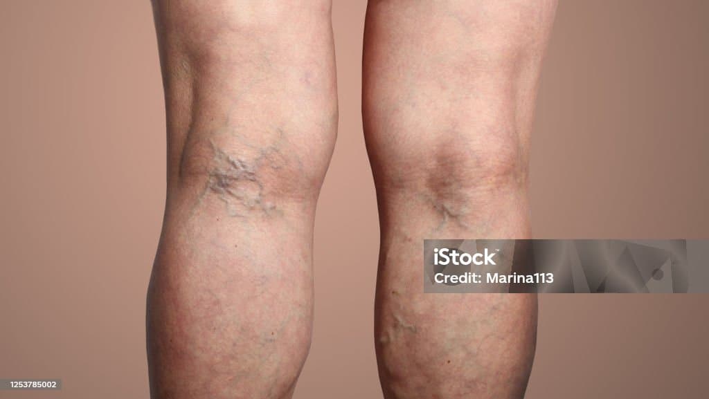 Antes del tratamiento